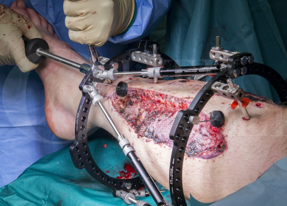 Tibial shaft fracture- Fixation with a Taylor Spatial Frame (TSF ...